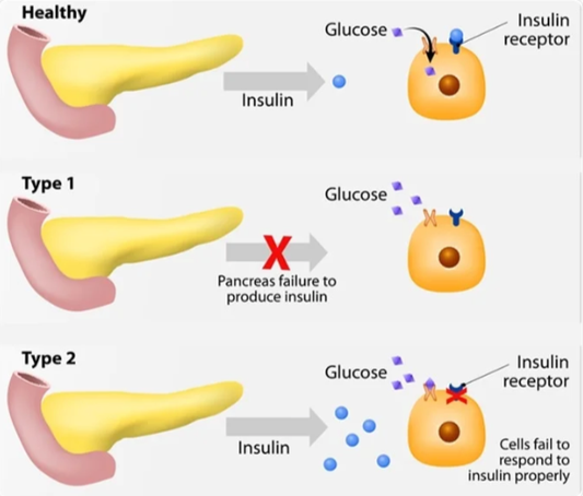 Diabetes Explained