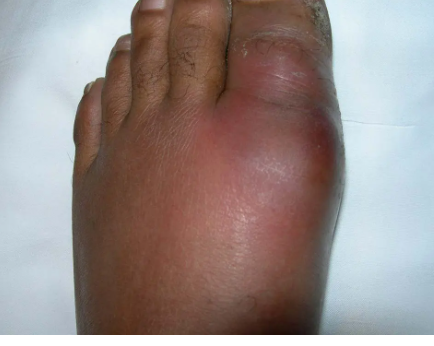 GOUT TO GO!