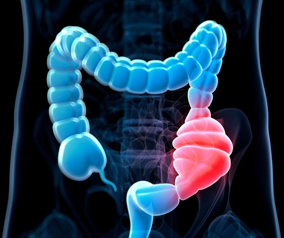 Difficulty with Bowel Movements?